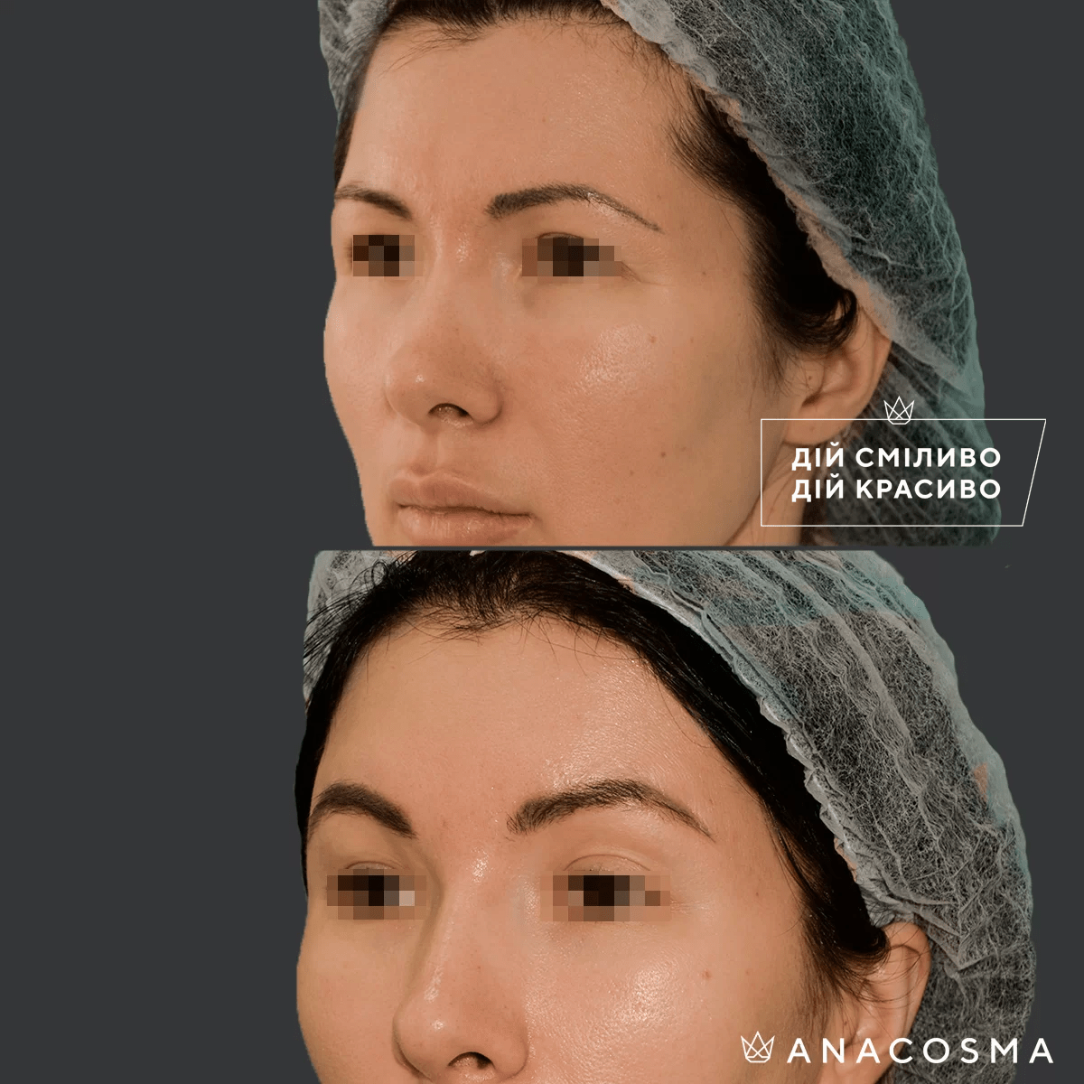 Підтяжка чола, ліфтинг брів до і після - Фото 2