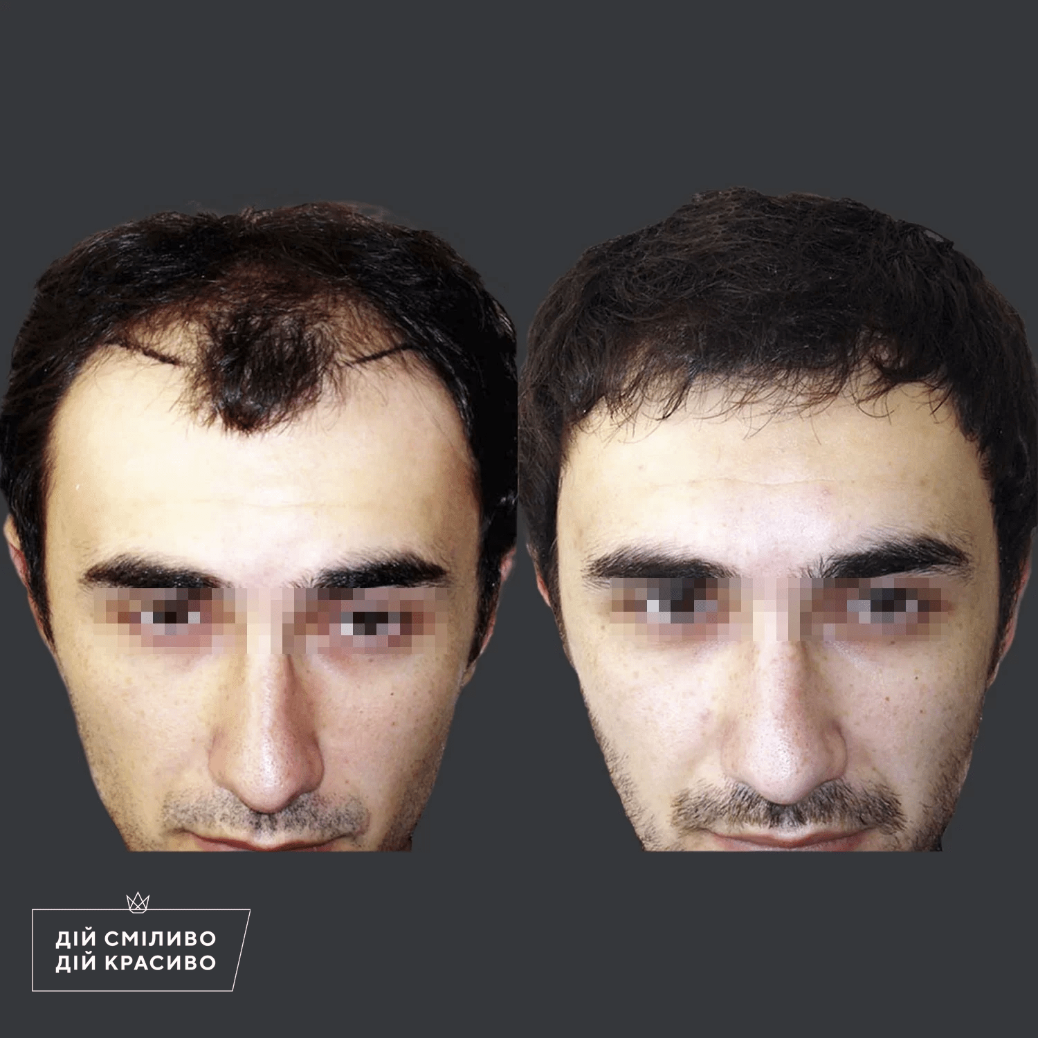 Пересадка волосся до і після - Фото 3