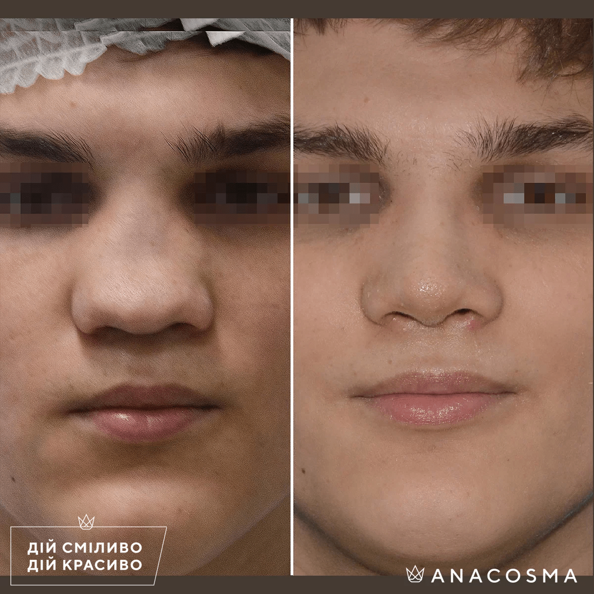 Ринопластика (пластика носа) до и после - Фото 4