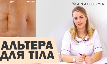 СМАС ліфтинг Альтера для ТІЛА 🔥 Прибрати в'ялий живіт, руки, коліна