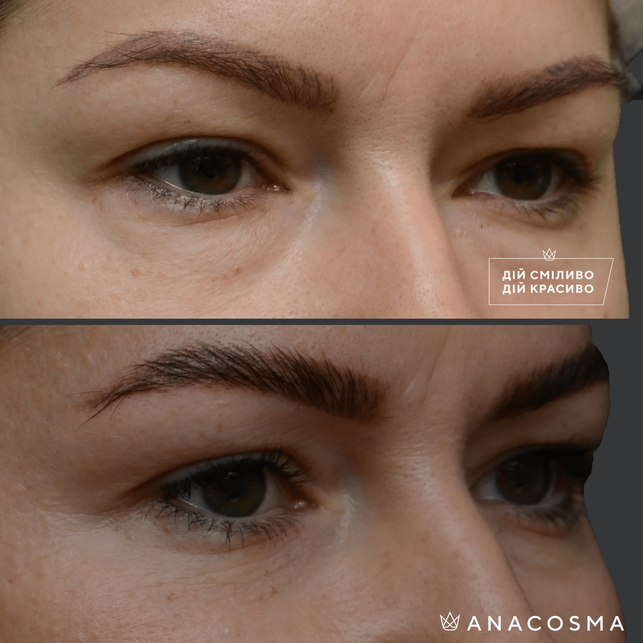 Blepharoplasty before and after - Photo 11