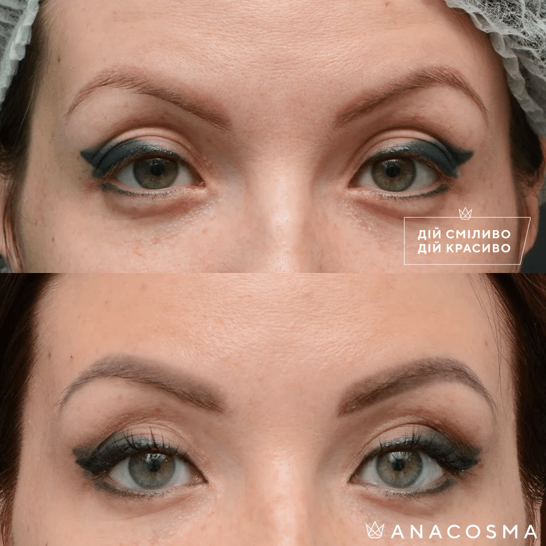 Blepharoplasty before and after - Photo 9