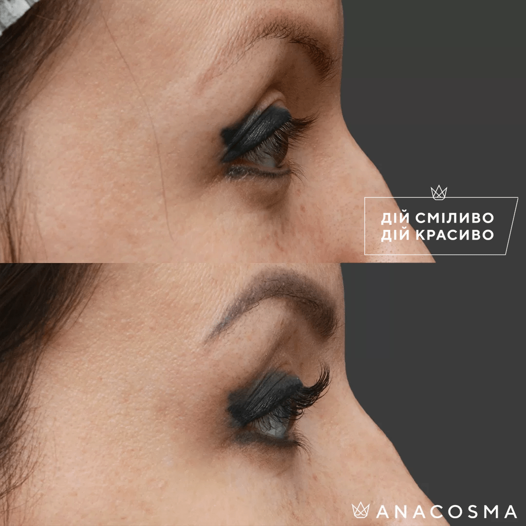 Blepharoplasty before and after - Photo 8