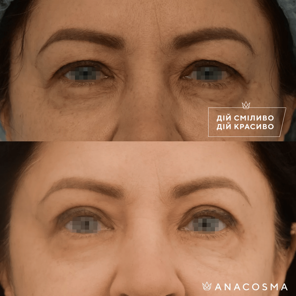 Blepharoplasty before and after - Photo 13