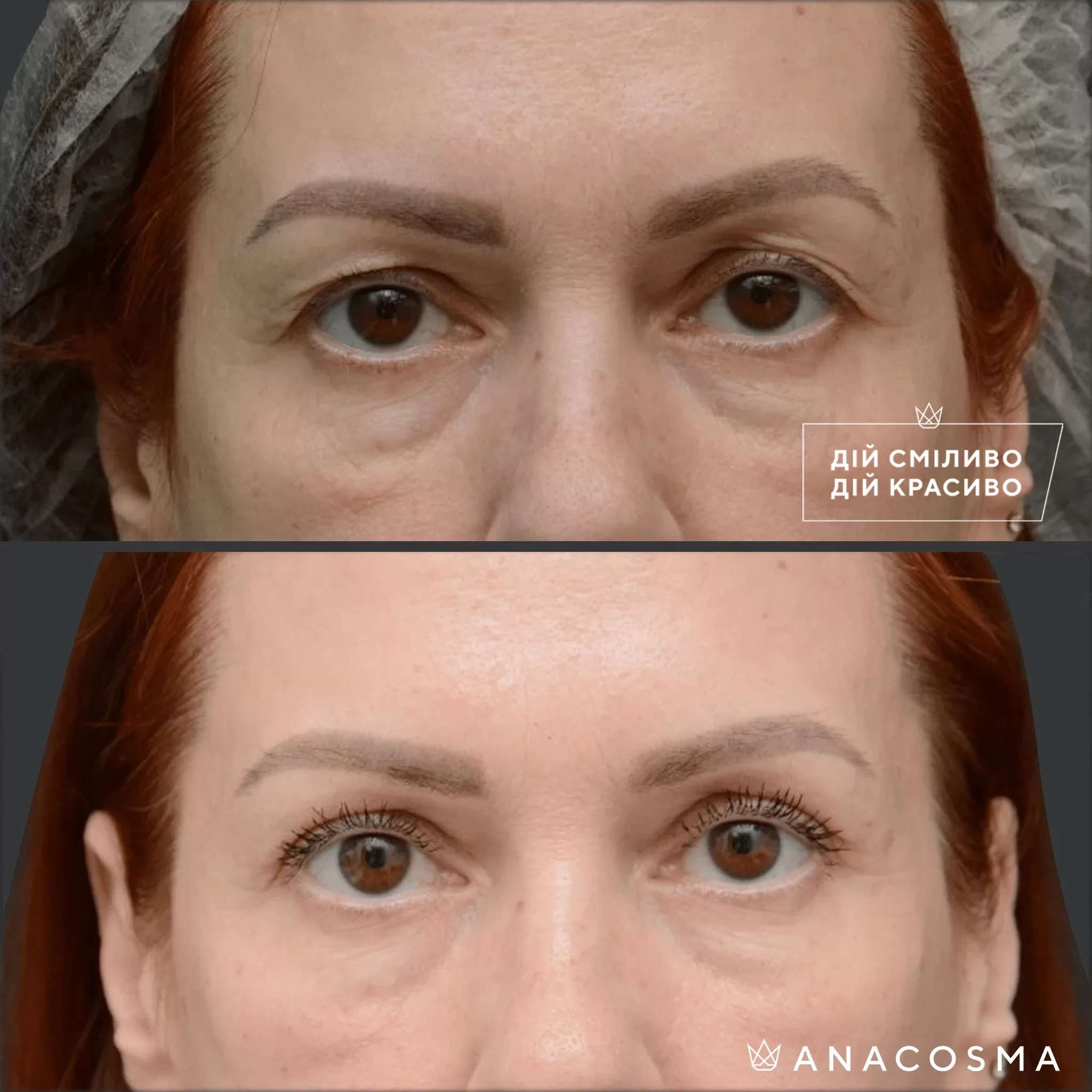 Blepharoplasty before and after - Photo 12