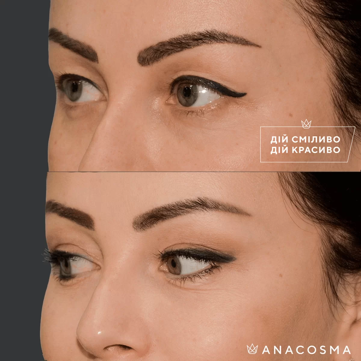 Blepharoplasty before and after - Photo 21