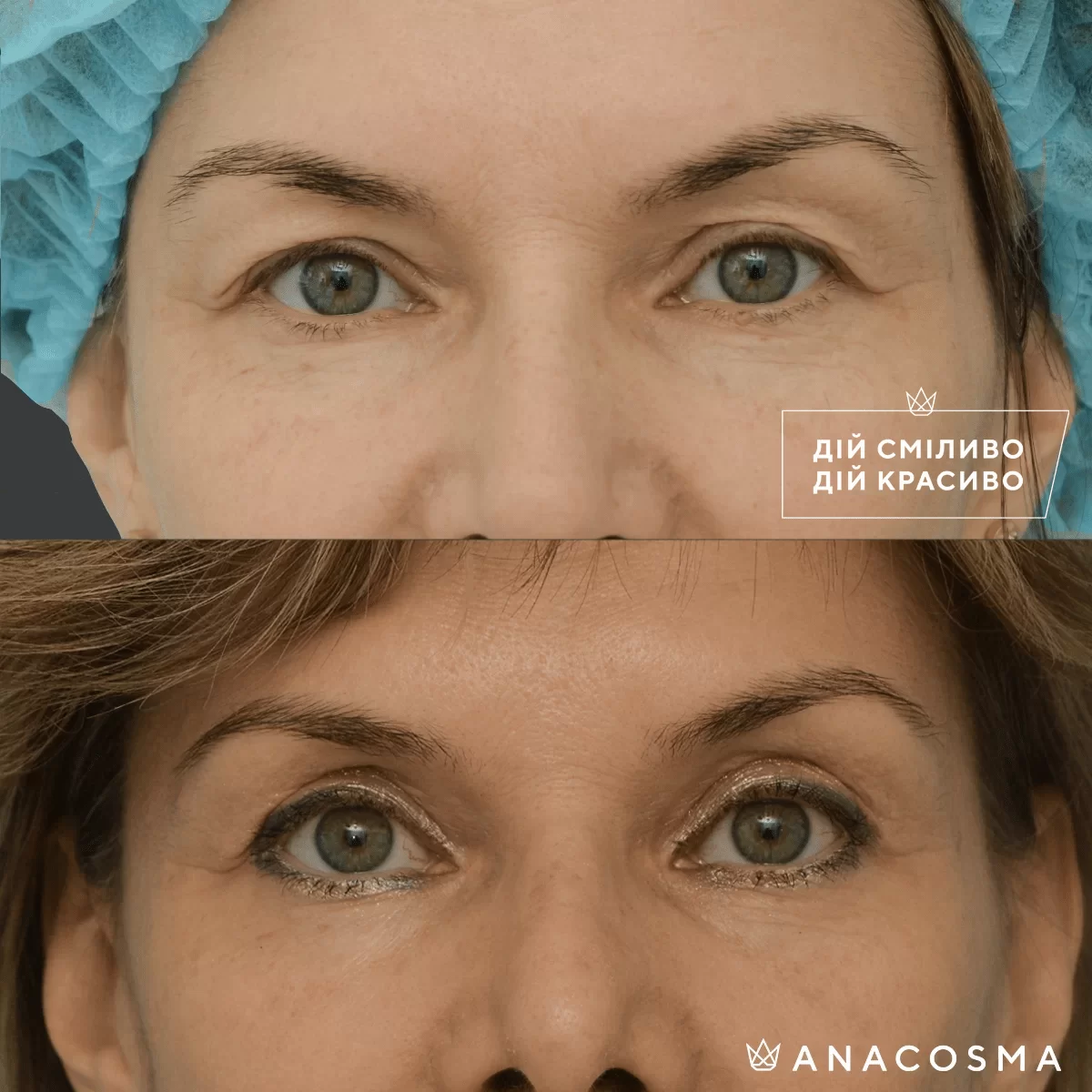 Blepharoplasty before and after - Photo 19