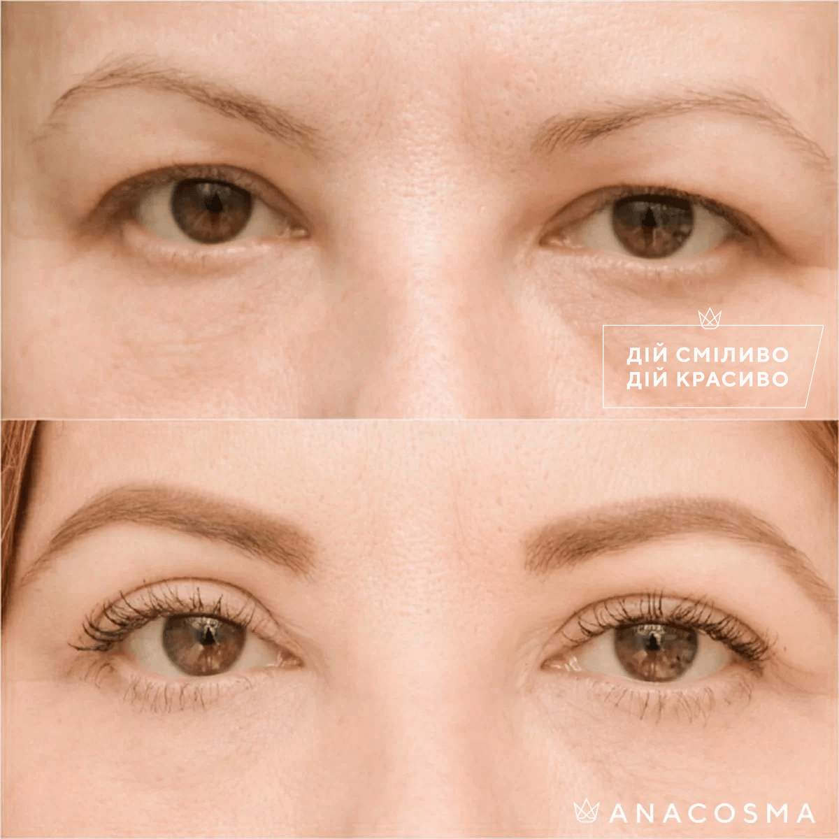 Blepharoplasty before and after - Photo 10