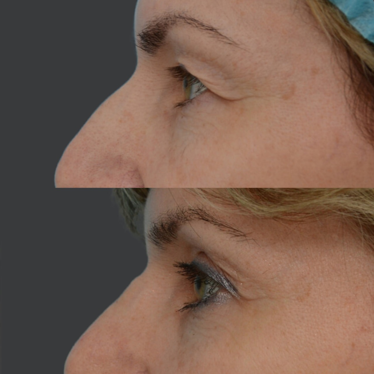 Blepharoplasty before and after - Photo 42