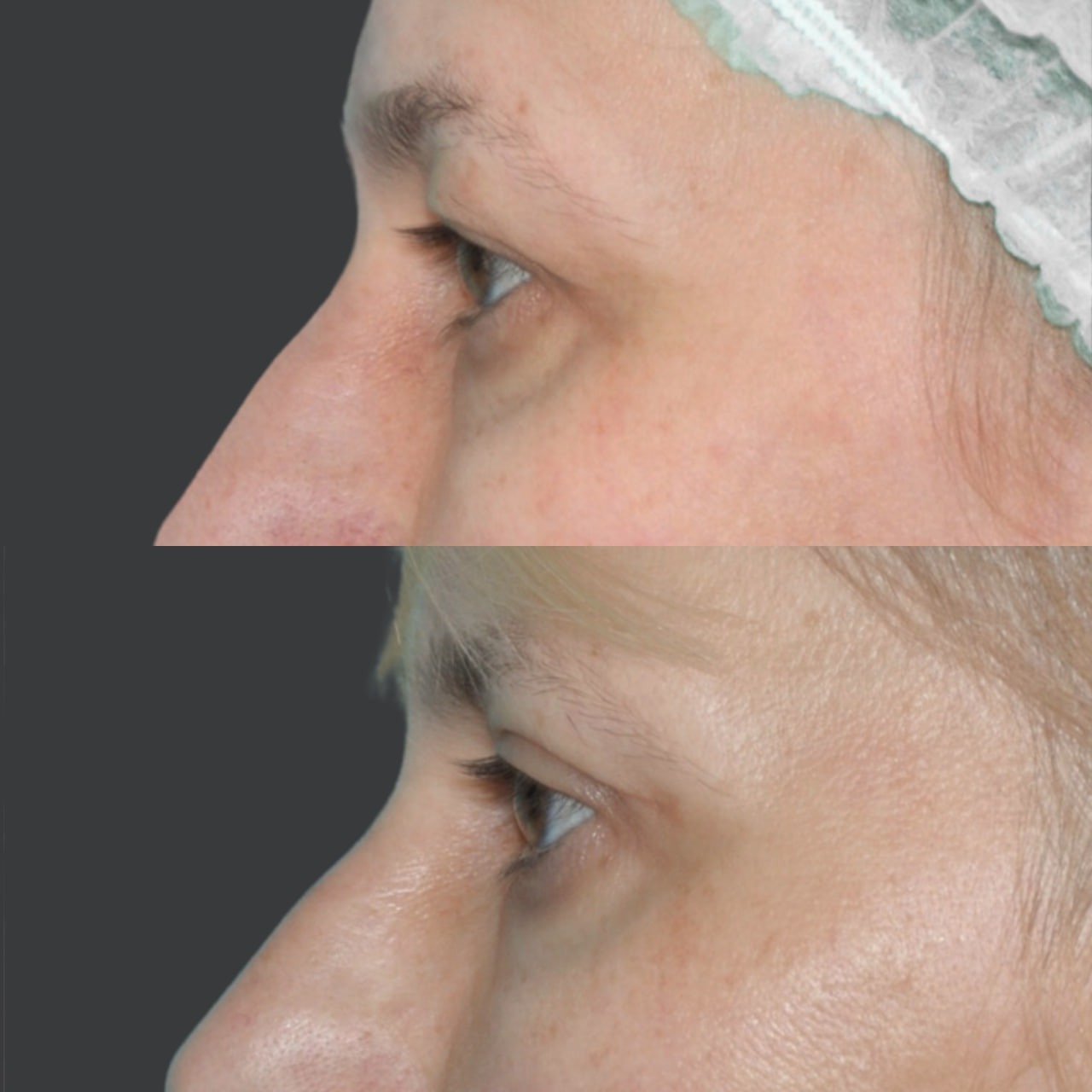 Blepharoplasty before and after - Photo 43