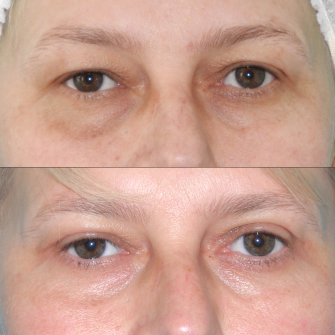 Blepharoplasty before and after - Photo 36