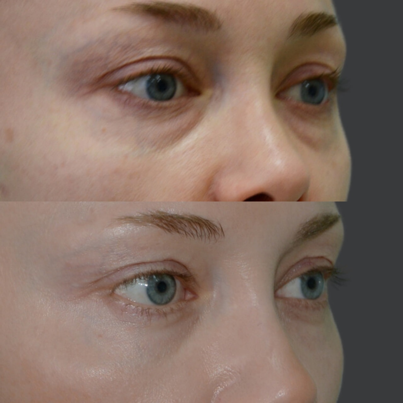Blepharoplasty before and after - Photo 35