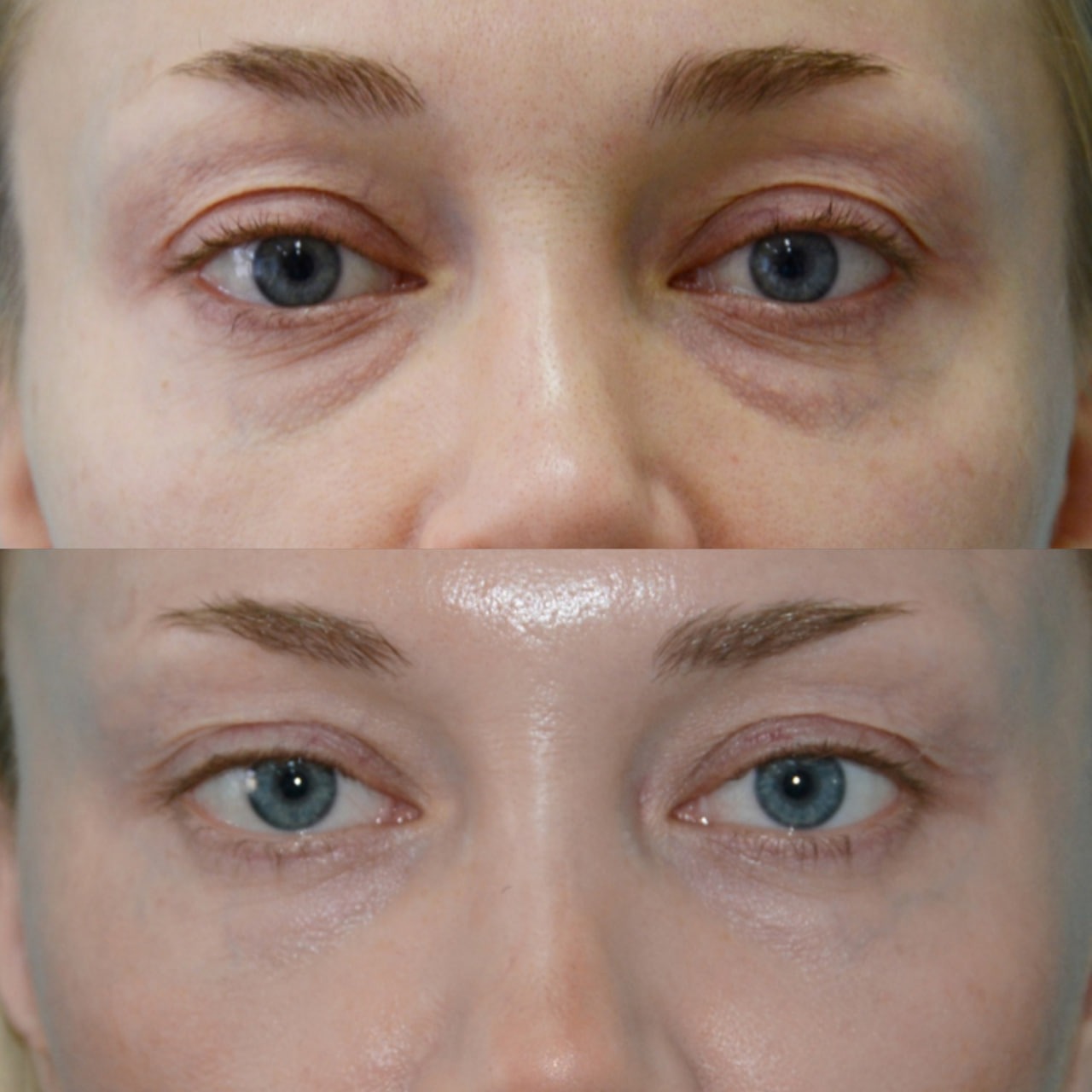 Blepharoplasty before and after - Photo 34