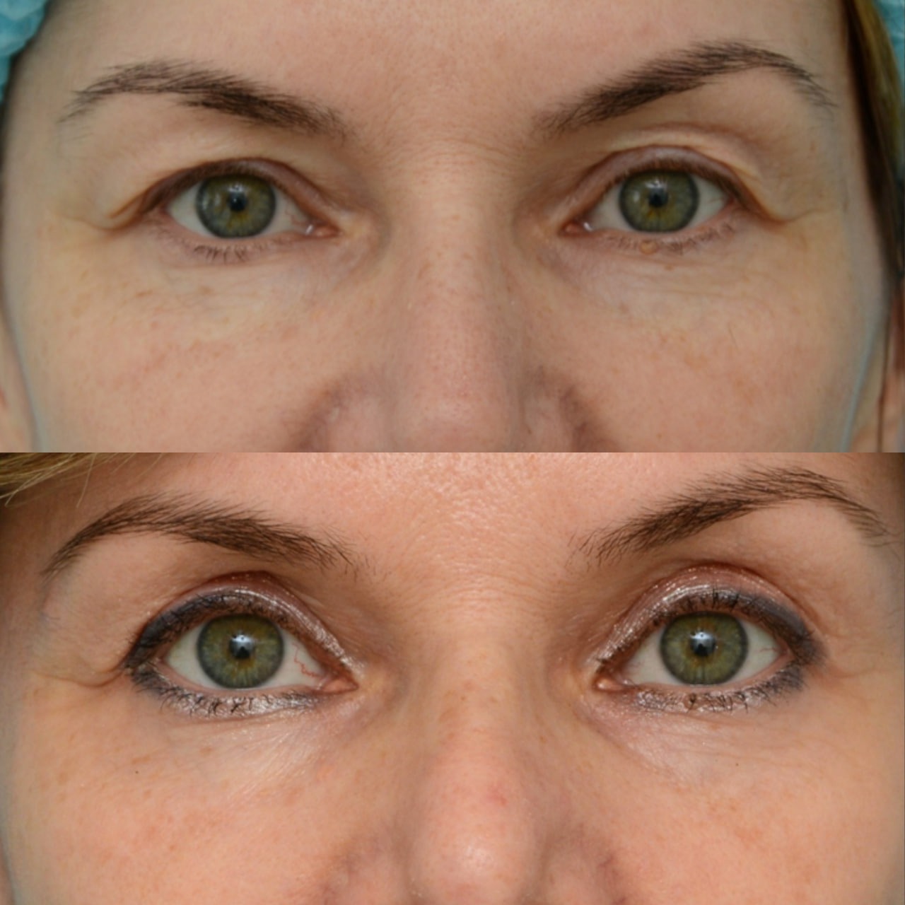 Blepharoplasty before and after - Photo 45