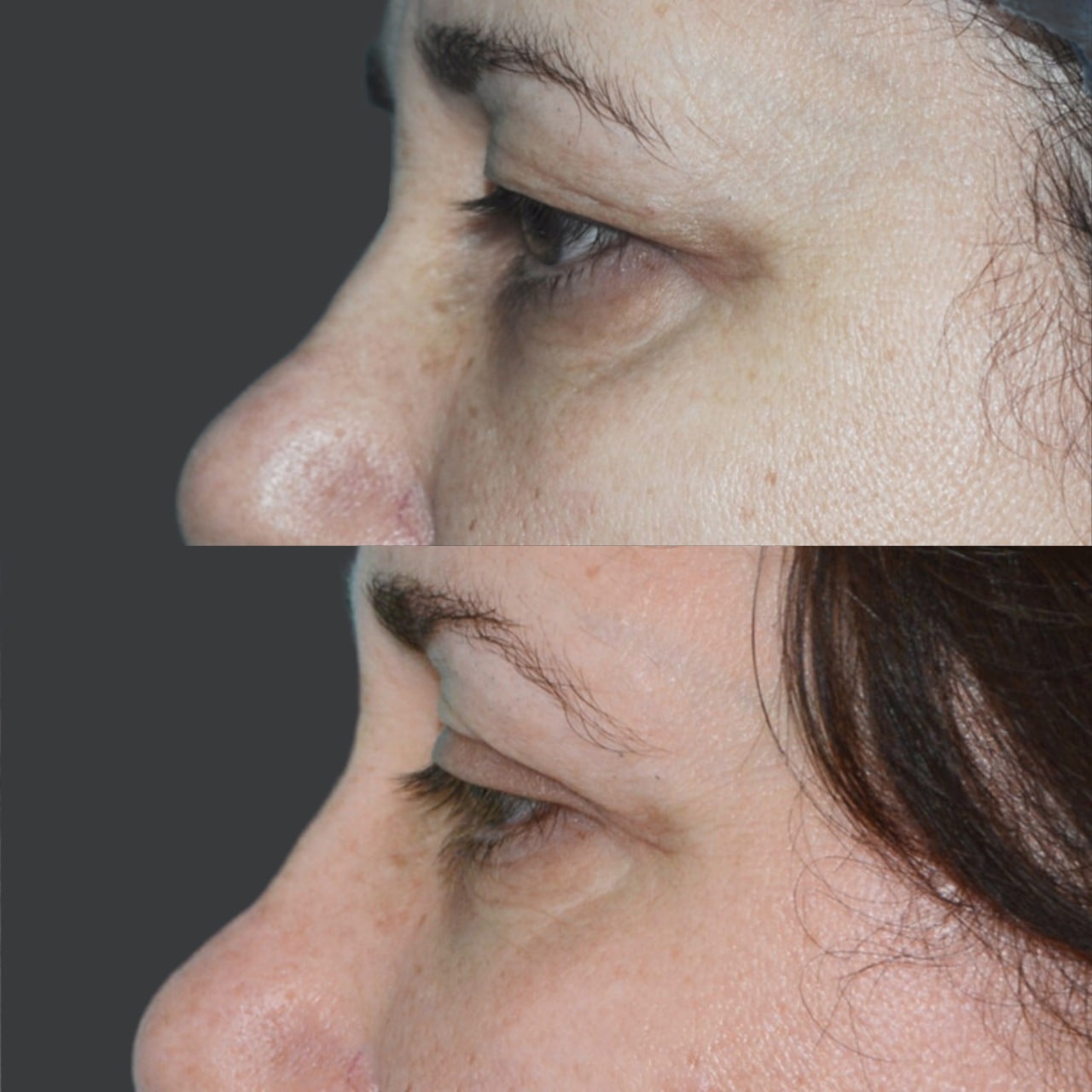 Blepharoplasty before and after - Photo 44