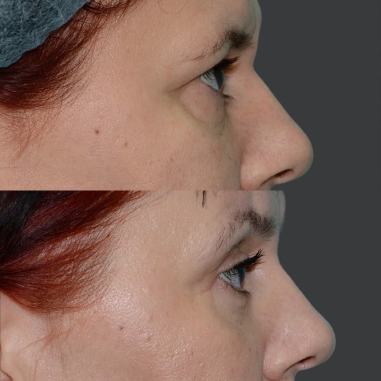 Blepharoplasty before and after - Photo 37