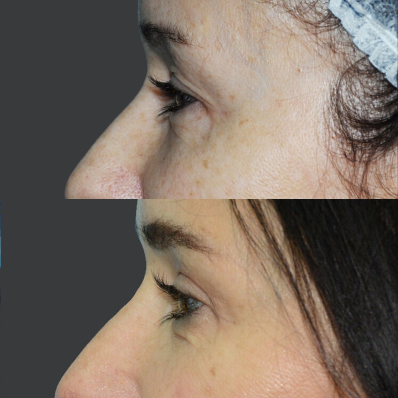 Blepharoplasty before and after - Photo 38