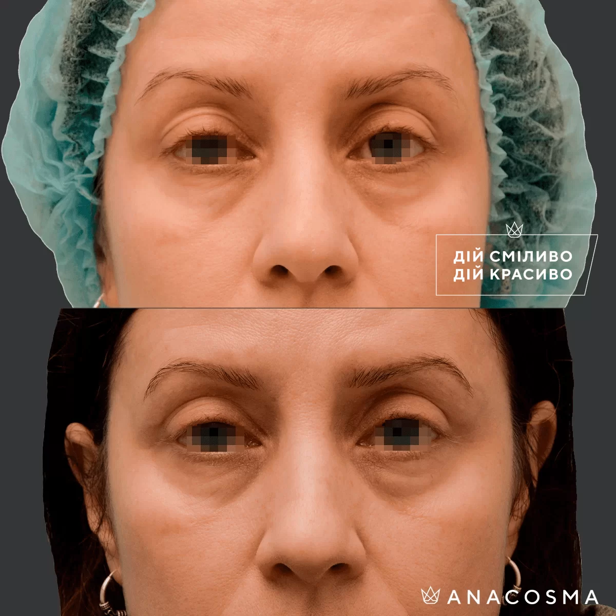 Blepharoplasty before and after - Photo 28