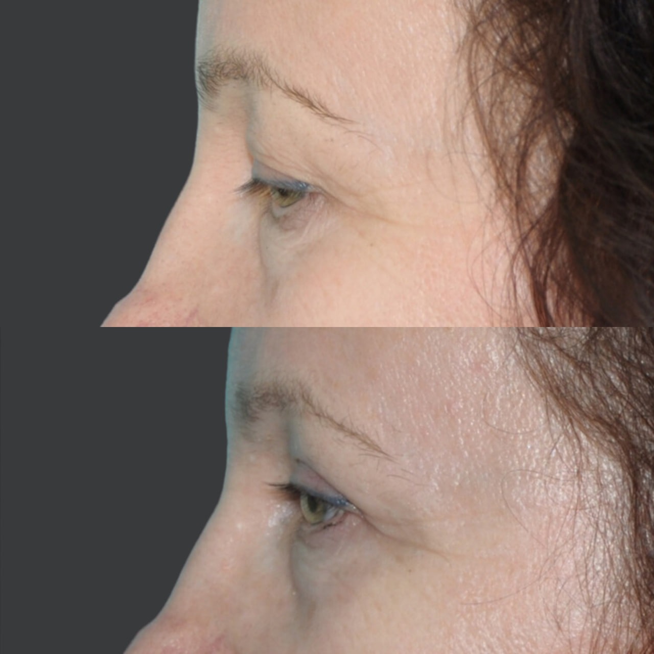 Blepharoplasty before and after - Photo 40