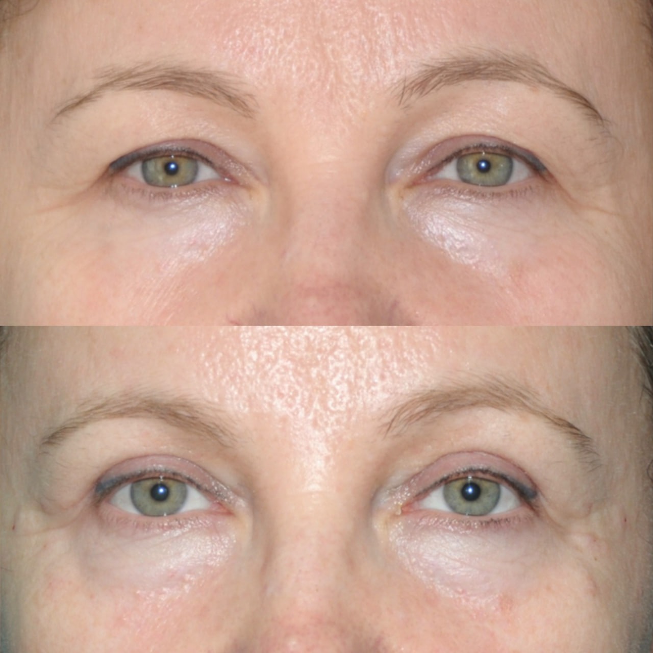 Blepharoplasty before and after - Photo 41