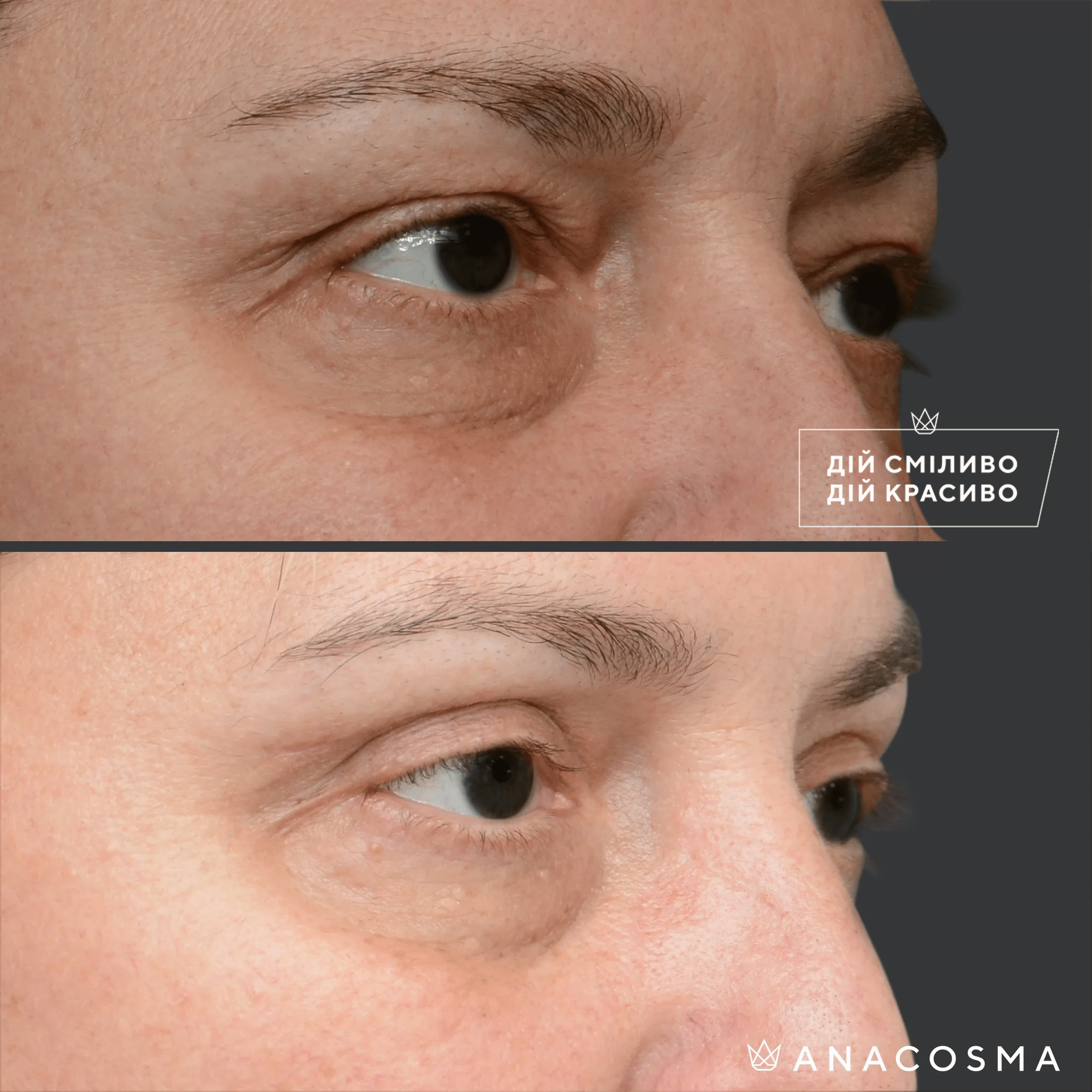 Blepharoplasty before and after - Photo 27