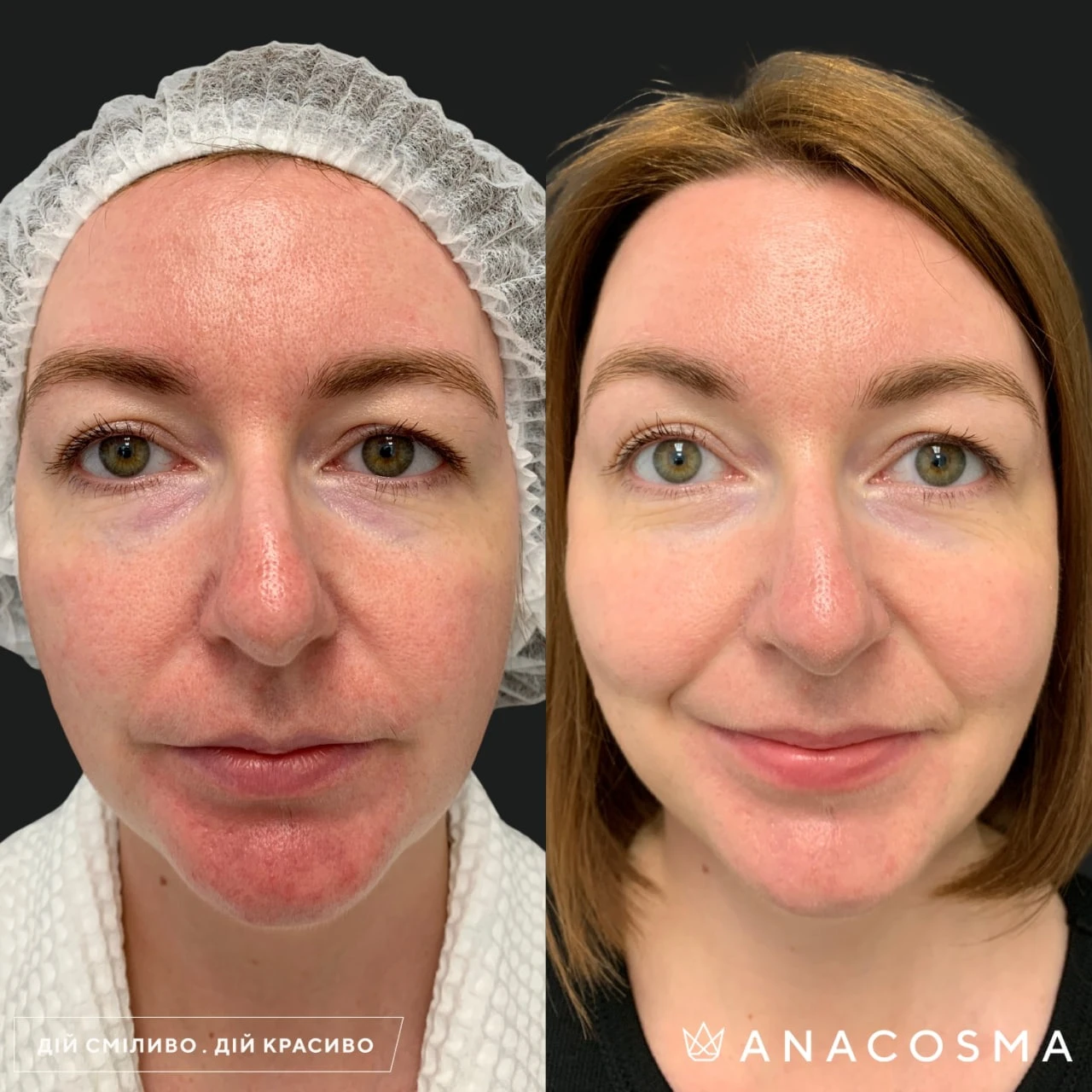 Laser Genesis — лазерное омоложение и сияние кожи до и после - Фото 6