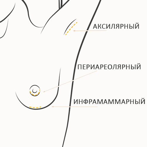 Збільшення грудей - Номер 2