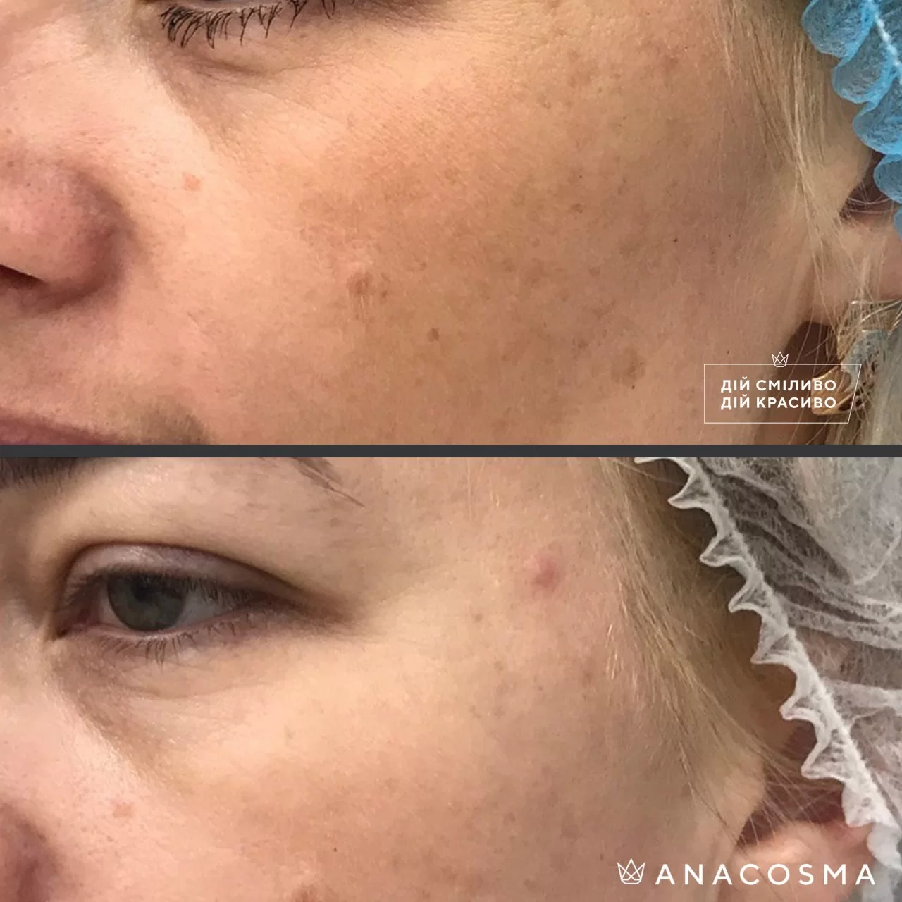 PHOTOREJUVENATION CUTERA LIMELIGHT before and after - Photo 1