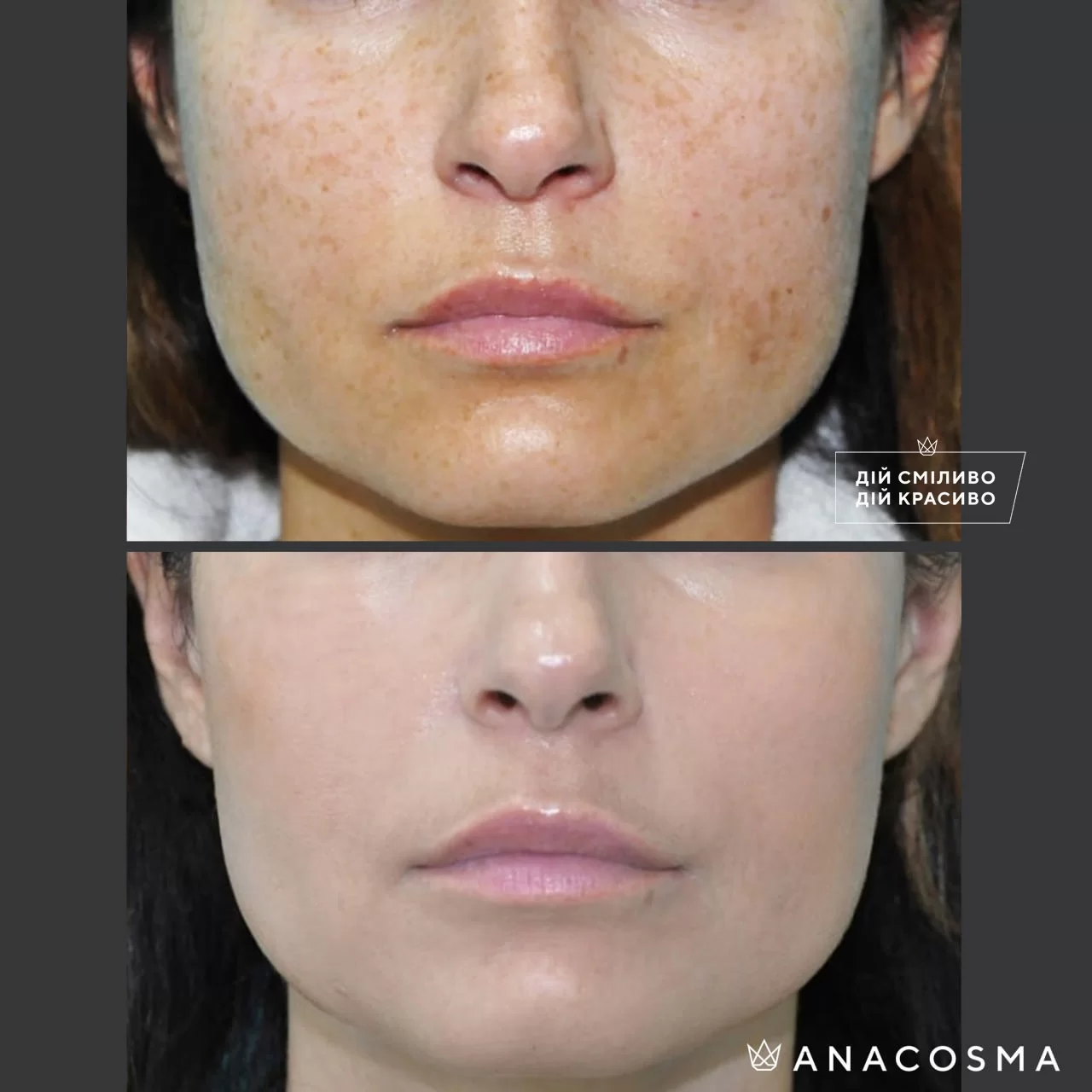 PHOTOREJUVENATION CUTERA LIMELIGHT before and after - Photo 2