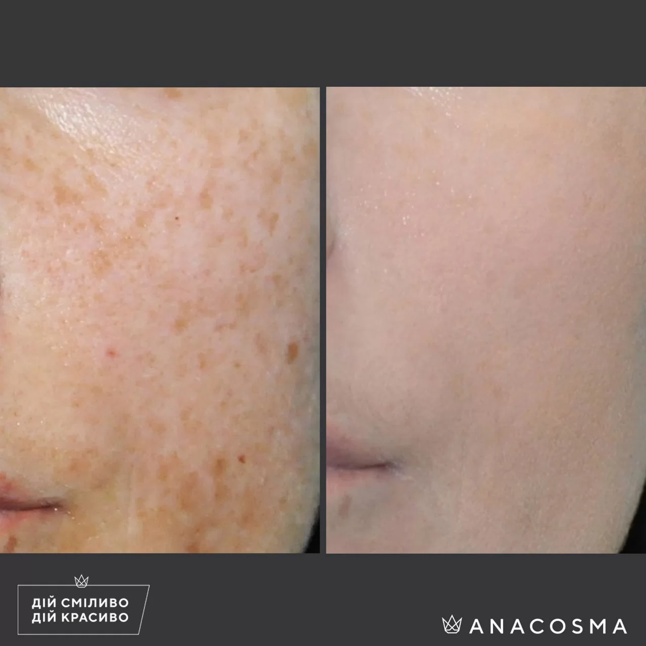 PHOTOREJUVENATION CUTERA LIMELIGHT before and after - Photo 3