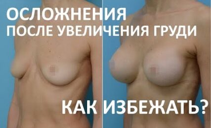 Ускладнення після операції збільшення грудей та як їх уникнути?