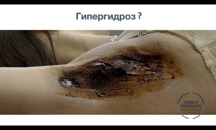 Тест на гіпергідроз: проба Мінора