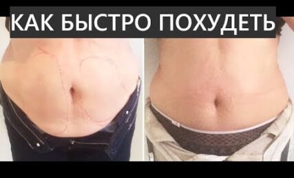 Що таке медичний кріоліполіз?