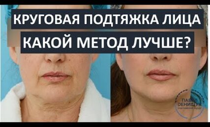 Які існують методи кругової підтяжки обличчя? Який кращий?