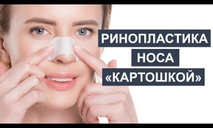 Ринопластика носу "картоплею": методи корекції (уколи чи пластика?)