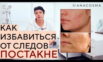 Як позбавитись від плям і рубців після акне?