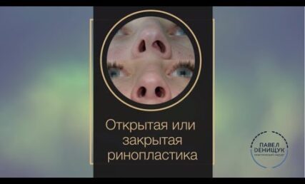 Закрытый и открытый метод пластики носа. Какой лучше?