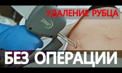 Про лазерне видалення рубців: коли шліфування шрамів можливе, а коли - заборонене