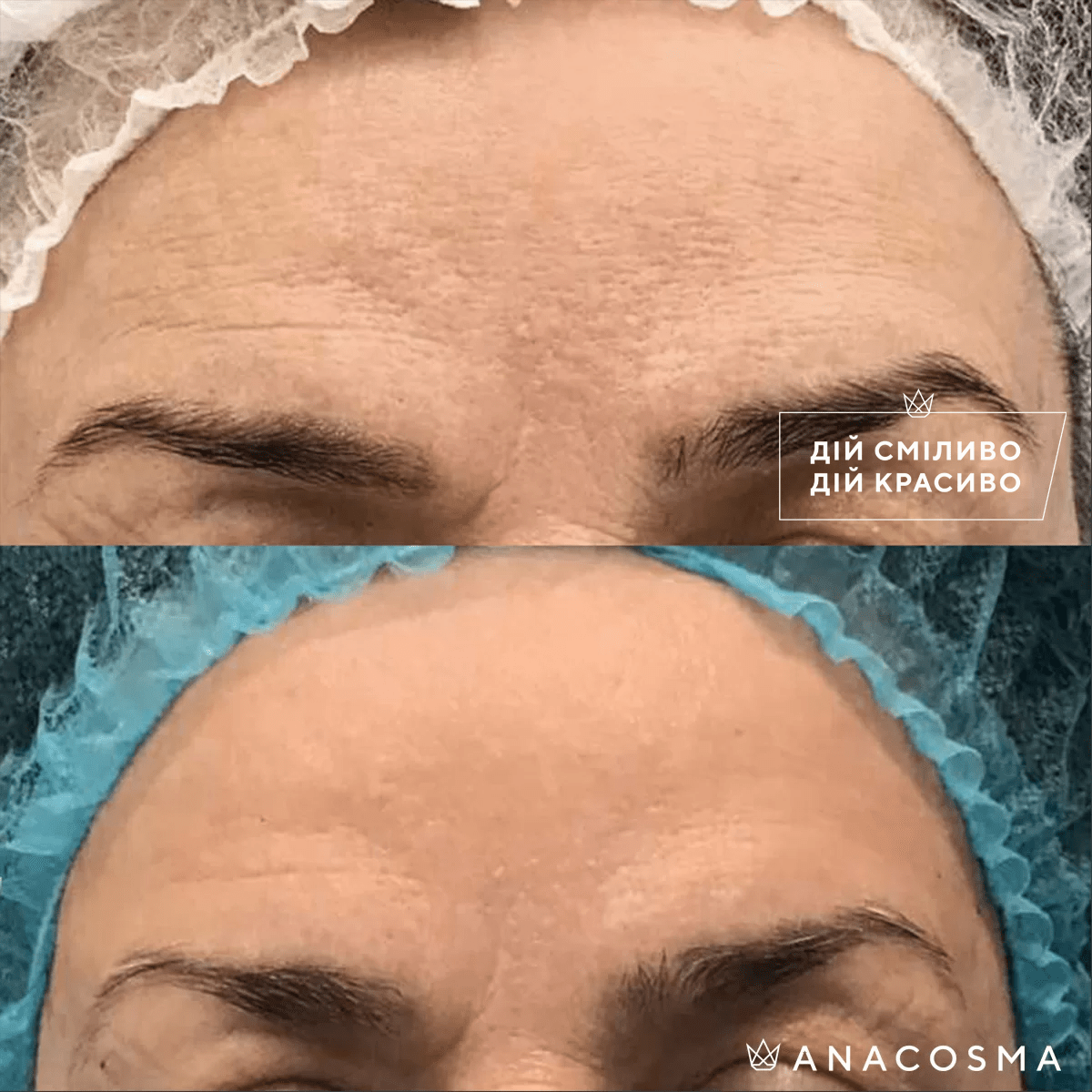 Laser Genesis — лазерне омолодження та сяйво шкіри до і після - Фото 4