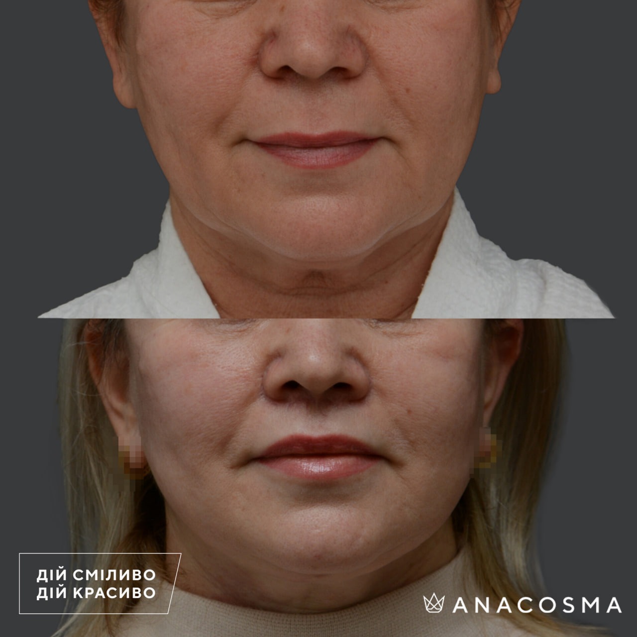 Circular facelift before and after - Photo 12