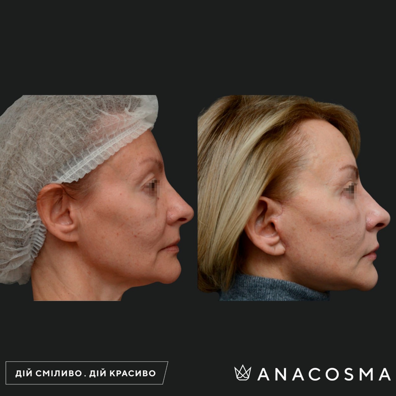 Circular facelift before and after - Photo 23