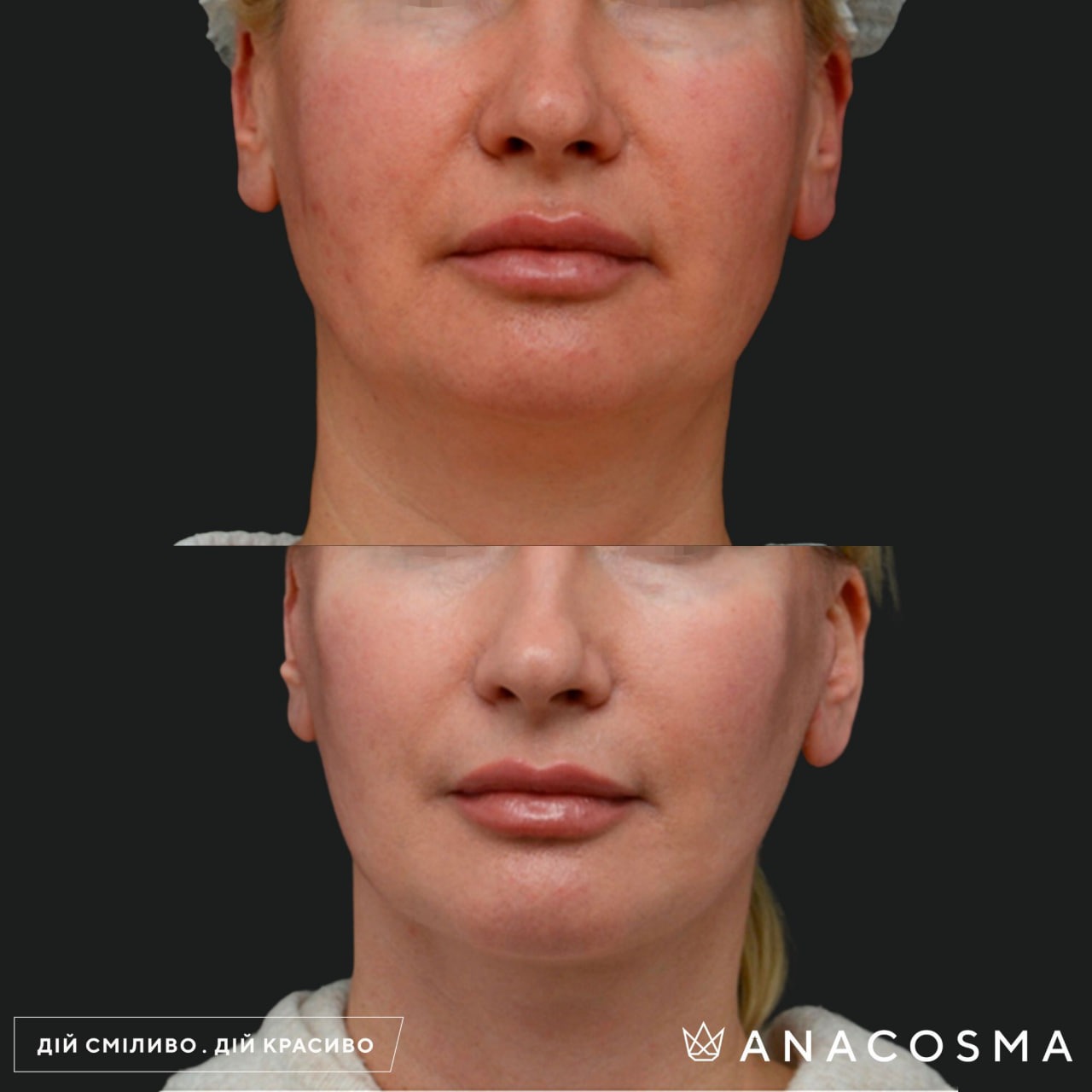 Circular facelift before and after - Photo 16