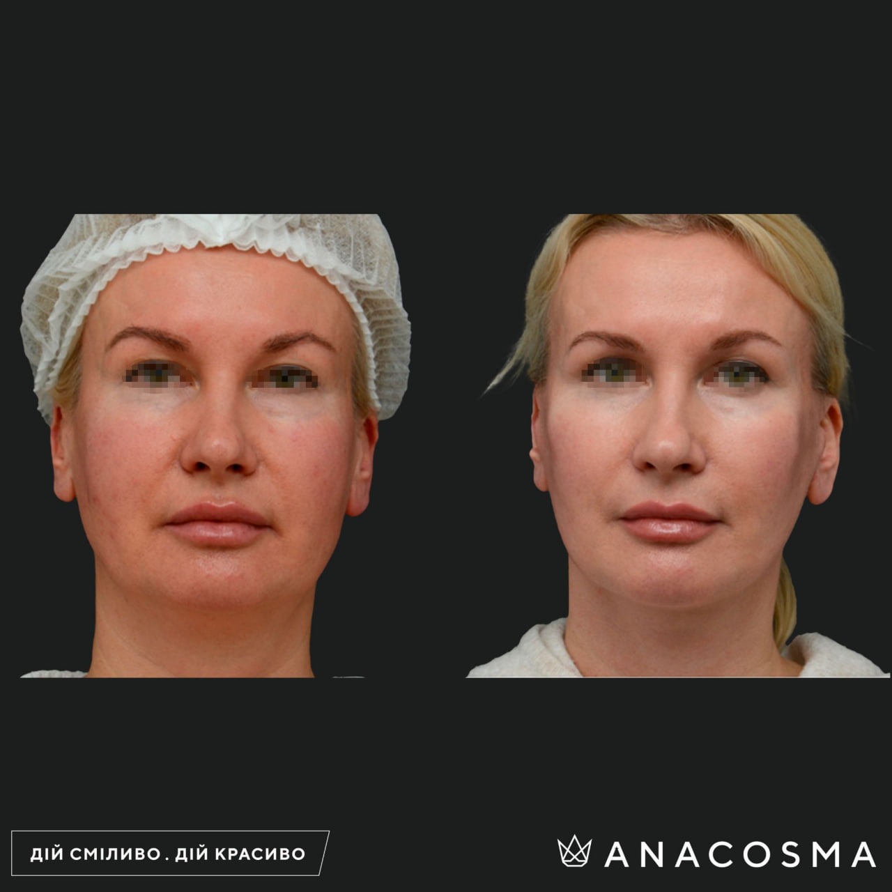 Circular facelift before and after - Photo 15