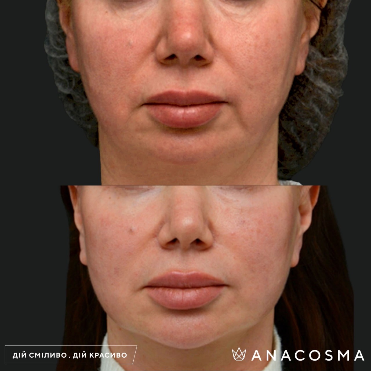 Circular facelift before and after - Photo 14