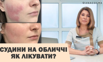 Судини на обличчі: купероз, розацеа - як лікувати?!