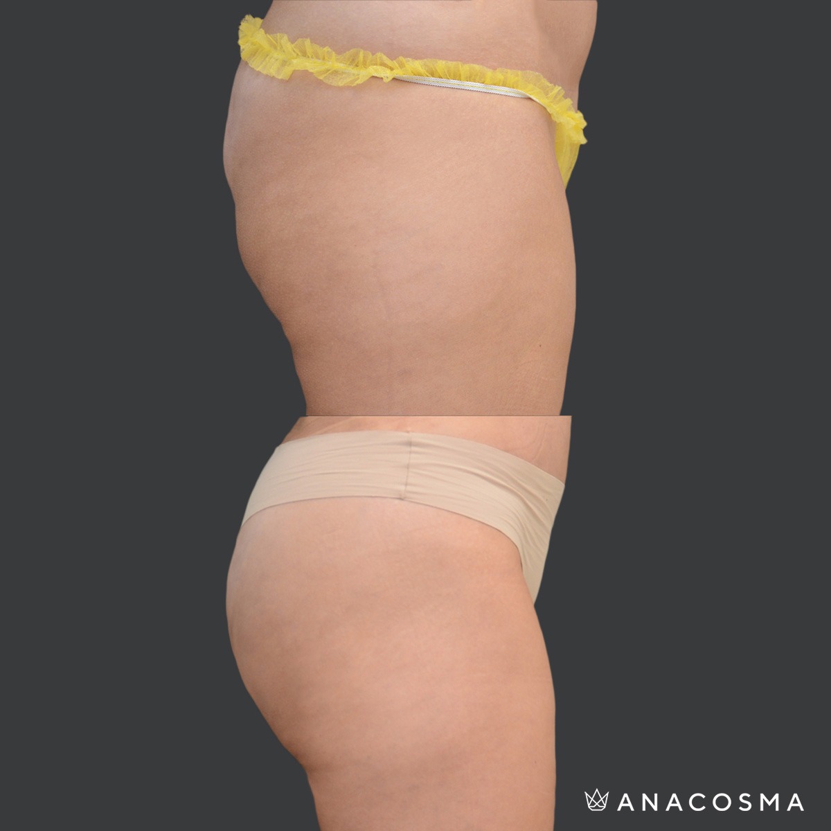 Buttock augmentation before and after - Photo 3
