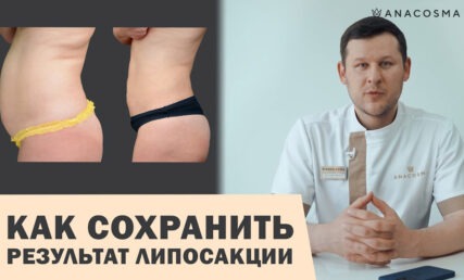 ЛИПОСАКЦИЯ ⛔ ОПАСНО ДО ПОХУДЕНИЯ ИЛИ ПОСЛЕ? ⚡