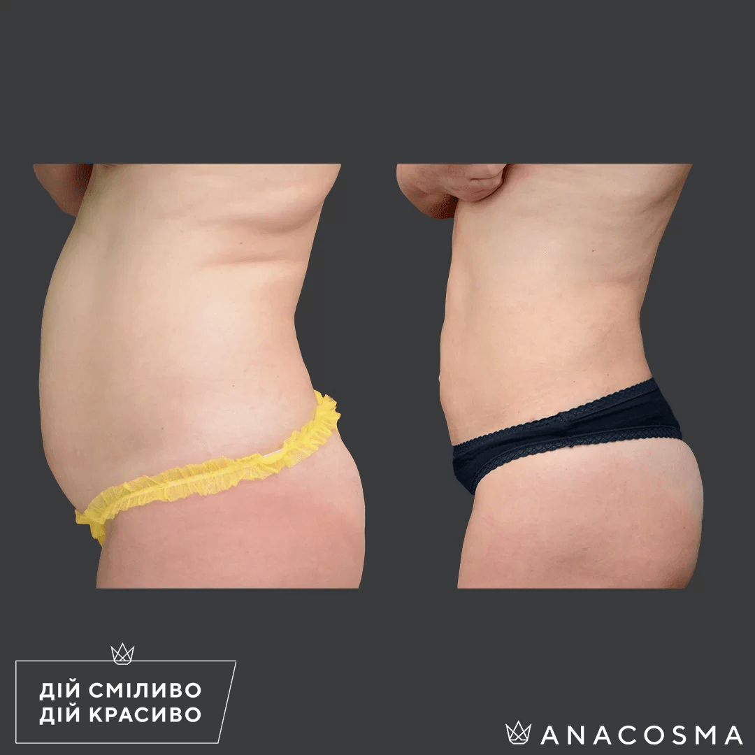 Ліпосакція живота та спини до і після - Фото 15