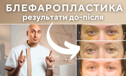 БЛЕФАРОПЛАСТИКА - РЕЗУЛЬТАТИ ДО-ПІСЛЯ