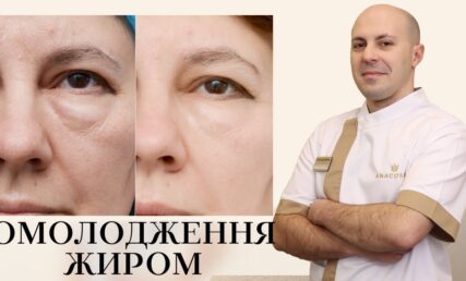 НАНОГРАФТИНГ VS ЛІПОФІЛІНГ ОСОБИ: ОМОЛОДЖЕННЯ ЖИРОМ 💉🔥 ЩО КРАЩЕ ⁉️